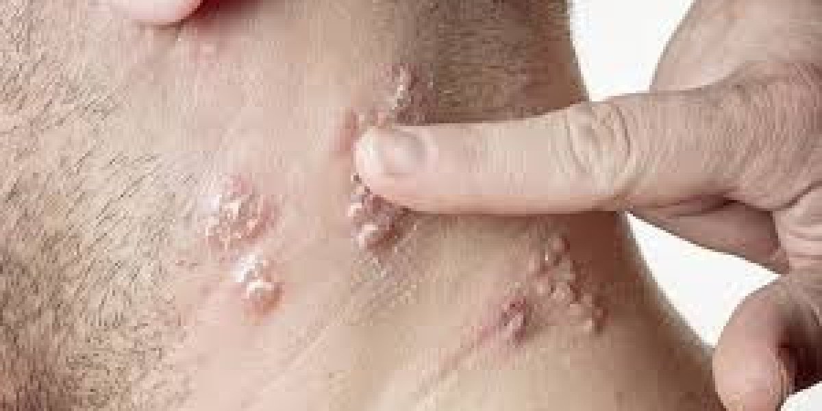 Topical Skin Infection Treatment Drug Pipeline Analysis Report 2024